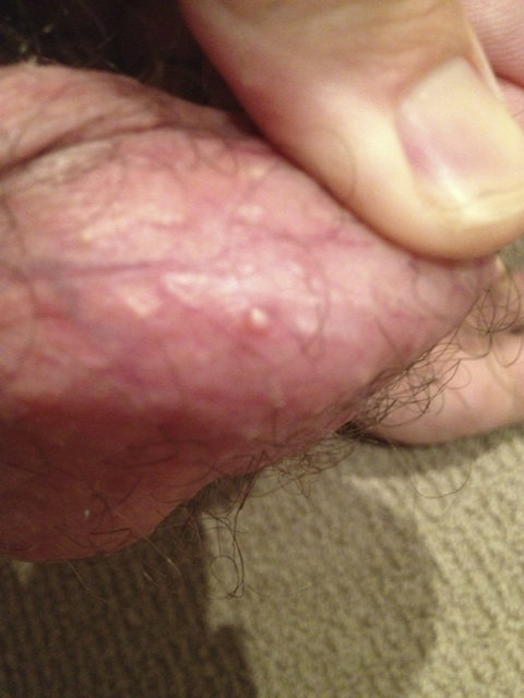 Molluscum Contagiosum On The Penis 112