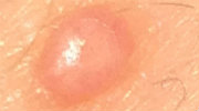 creams to treat molluscum contagiosum. There is a natural home remedy 