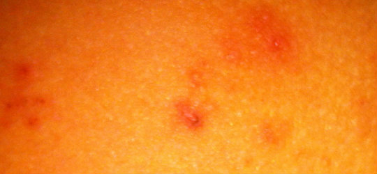 If molluscum bumps are scratched infection usually takes hold and inflames the surrounding skin. If the pus has spread onto the skin more molluscum bumps will soon follow.