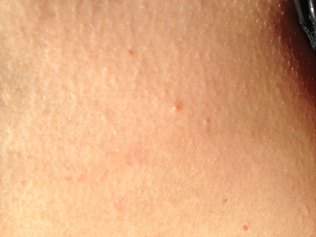 Molluscum contagiosum pus head with beginning stage bumps.