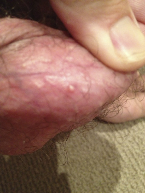 Cock pimple on What Can