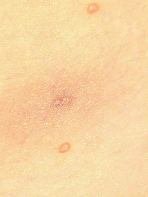 A molluscum pierced by a Doctor which became infected for which the Doctor prescribed antibiotics but no further treatment was suggested for the molluscum. 